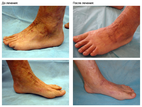 scar-foot
