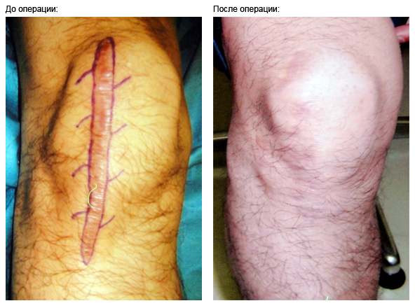 knee-scar2