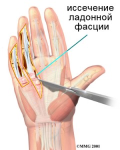 hand_dupuytrens_surgery02