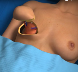 Breast
